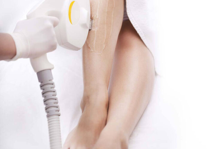Épilation définitive des jambes au laser à Marseille